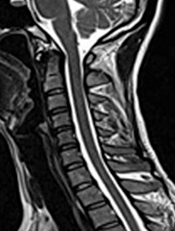 후종인대골화증 정상 MRI