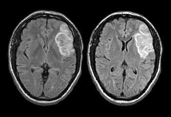 뇌졸중 증상 MRI 촬영