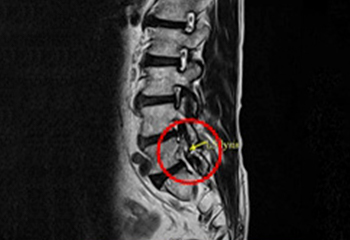 척추분리증 MRI