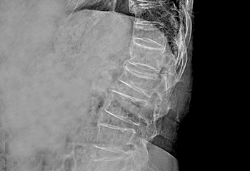 요추압박골절 X-RAY